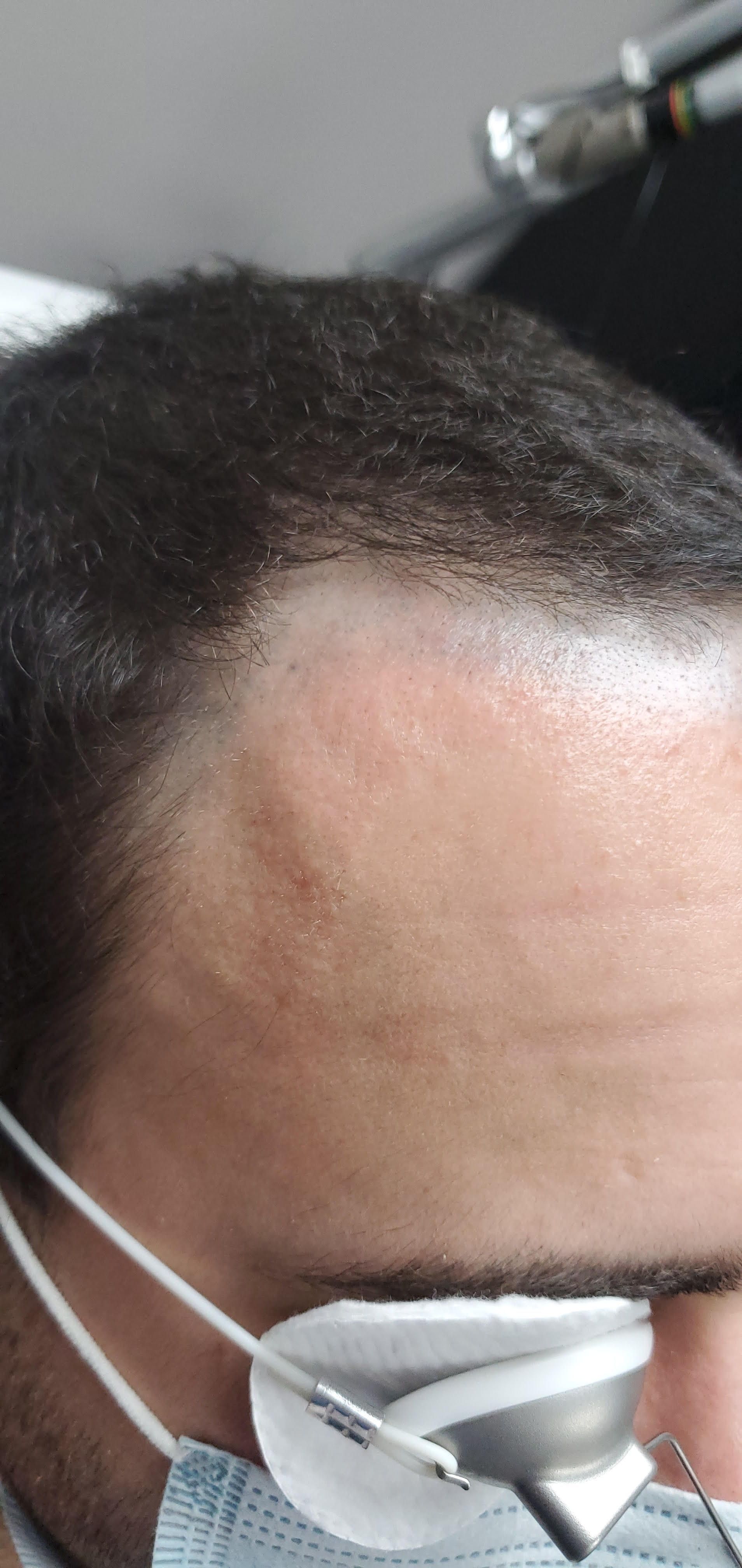 Close-up of a person wearing a white face mask, showing the forehead and side of the head.