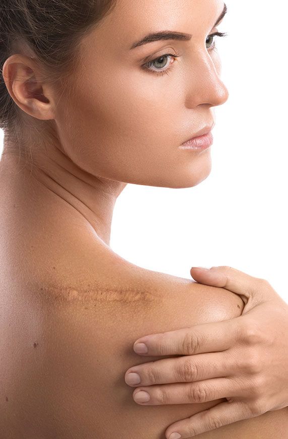 Frau mit heller Haut und brauner Narbe an der Schulter. Berührt die eigene Schulter und blickt weg.