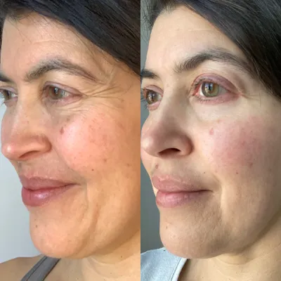 A before and after photo of a woman 's face.