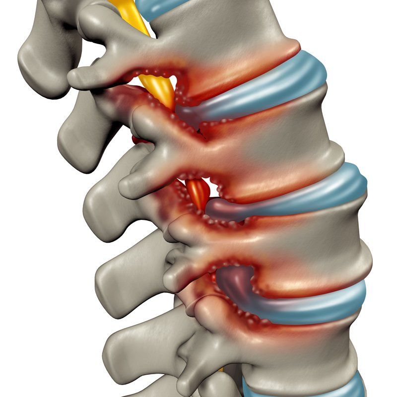 Spinal Stenosis Diagnosed