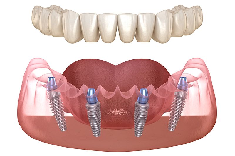 ALL-ON-4 IMPLANTS