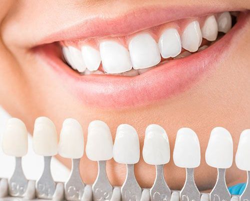 PORCELAIN VENEERS