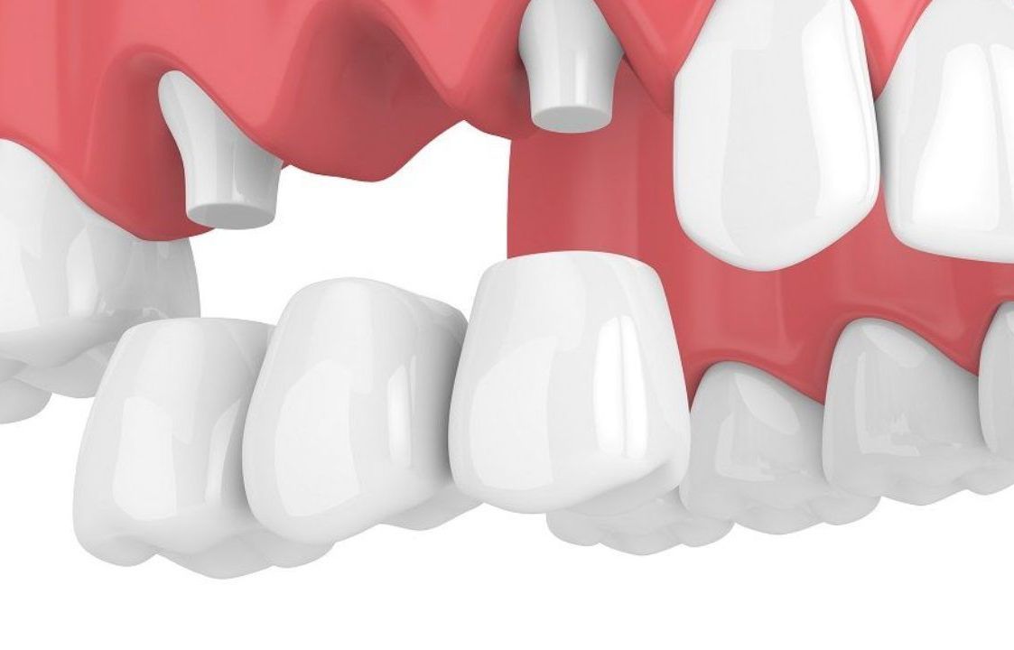 DENTAL BRIDGES