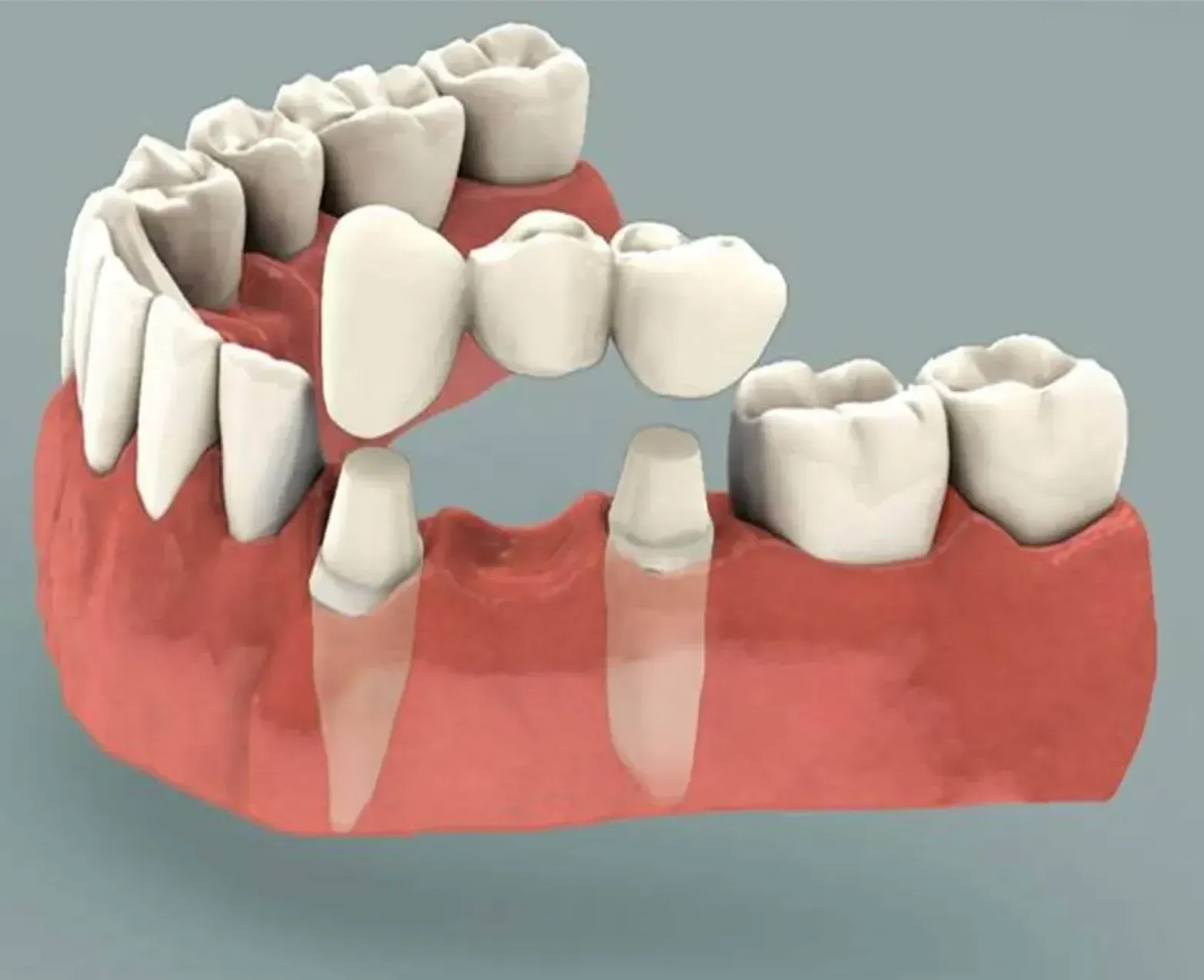 DENTAL BRIDGES