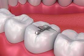 DENTAL FILLINGS