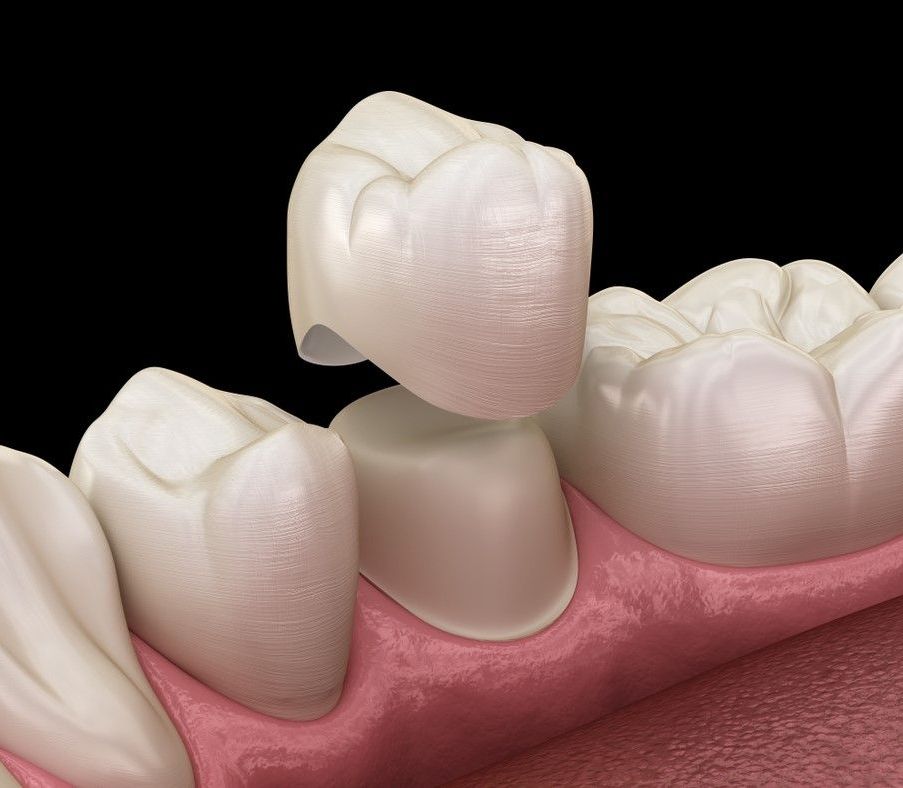 DENTAL CROWNS