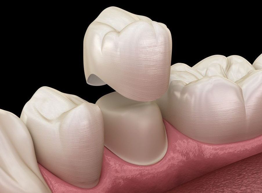 DENTAL CROWNS