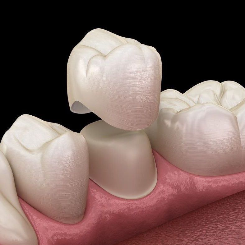 DENTAL CROWNS