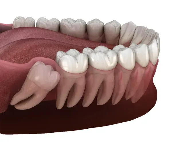 WISDOM TOOTH EXTRACTION