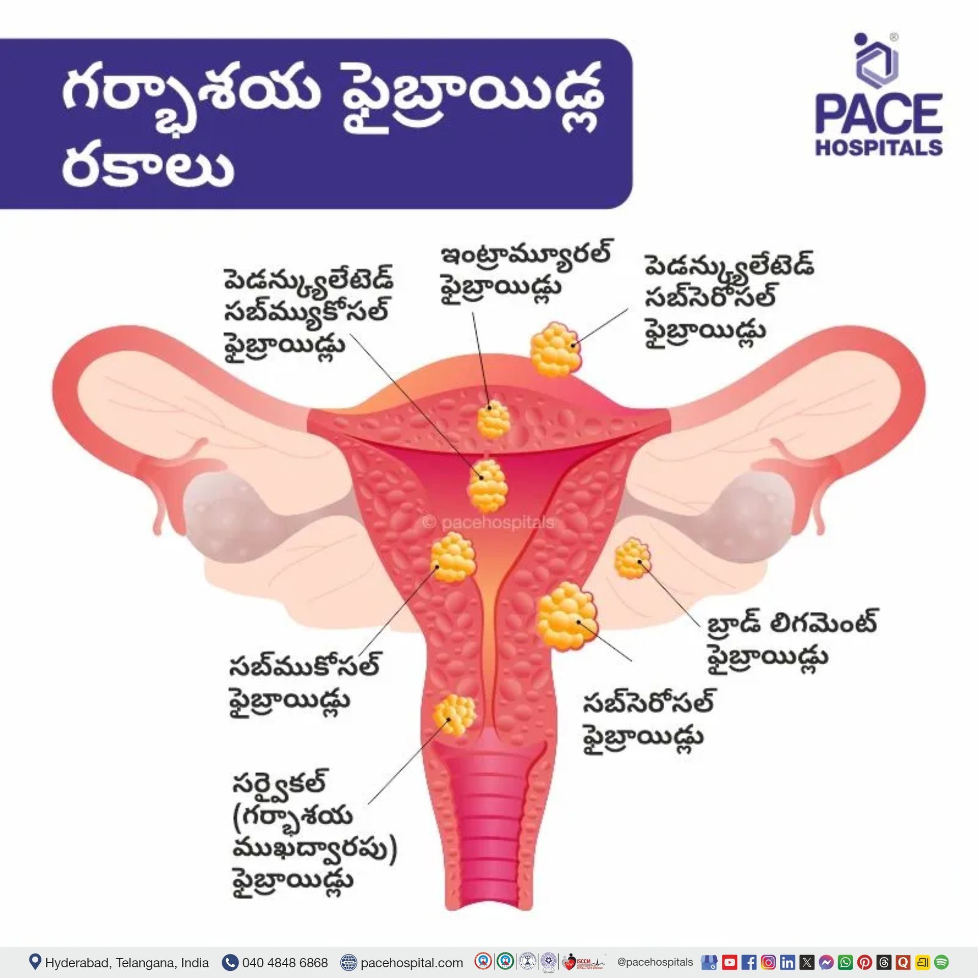Uterine fibroids meaning in telugu | types of uterine fibroids in telugu | uterine fibroids pictures images | uterine fibroid classification in telugu | intramural uterine fibroid | subserosal uterine fibroid