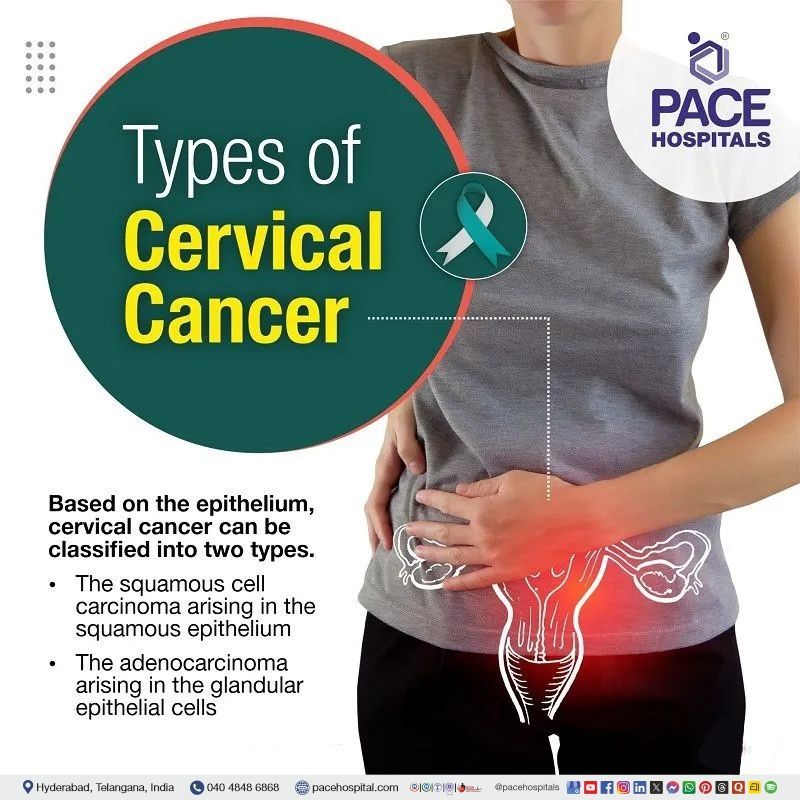 Cervical Cancer Types types of cervical cancer