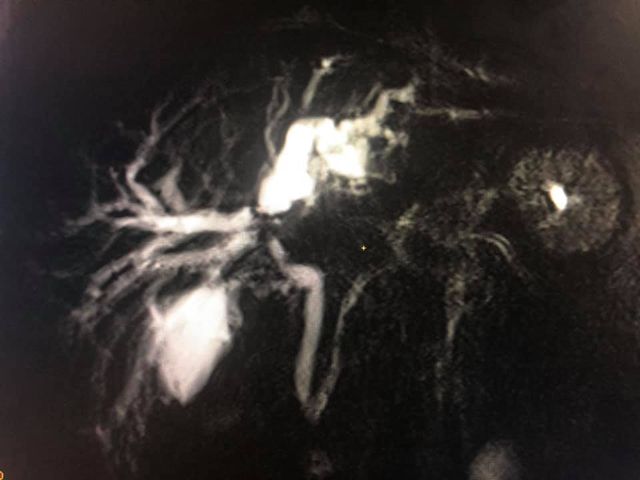 3A hilar cholangiocarcinoma (complex hepatobiliary malignancy) with deep jaundice
