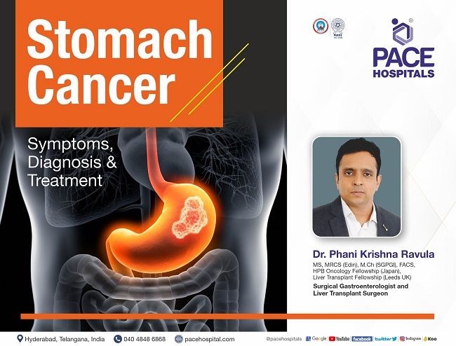 Stomach Cancer (Gastric Cancer) - Symptoms, Diagnosis and Treatment | Symptoms of Stomach Cancer