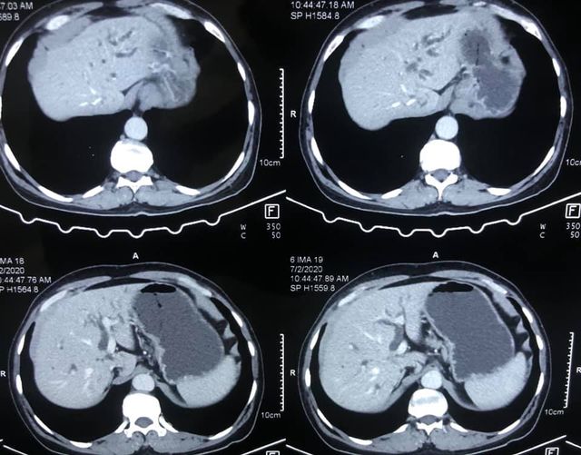 3A hilar cholangiocarcinoma (complex hepatobiliary malignancy) with deep jaundice