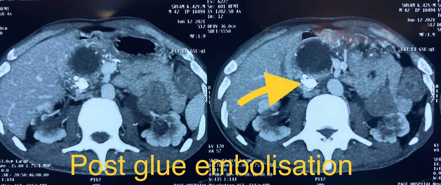40 year old male with idiopathic chronic pancreatitis - post glue embolisation