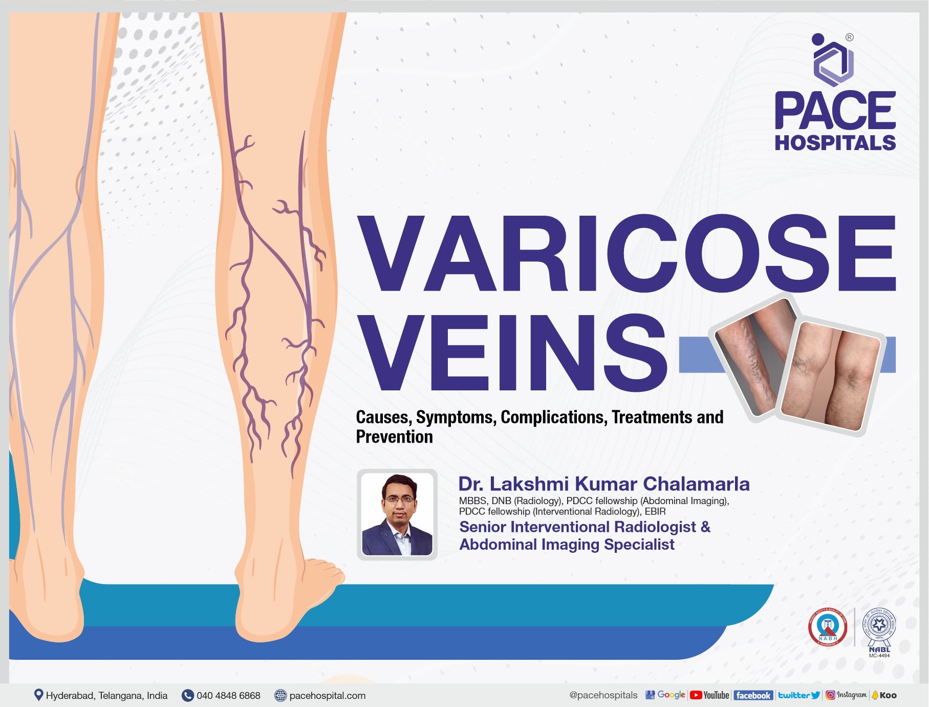Varicose Veins - Causes, Symptoms, Complications, Treatments and Prevention | Dr Lakshmi Kumar Chalamarla