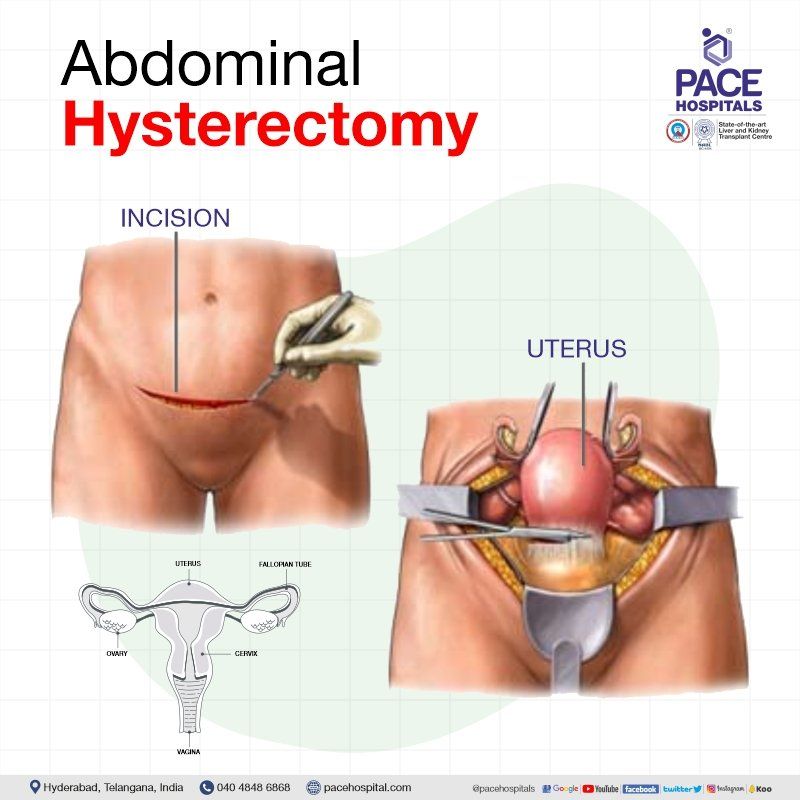 Abdominal hysterectomy in Hyderabad | Abdominal hysterectomy in India | Abdominal hysterectomy procedure | Abdominal hysterectomy surgery | Total abdominal hysterectomy