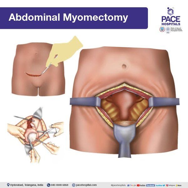 Abdominal Myomectomy in Hyderabad | Laparotomy in Hyderabad | Laparotomy surgery