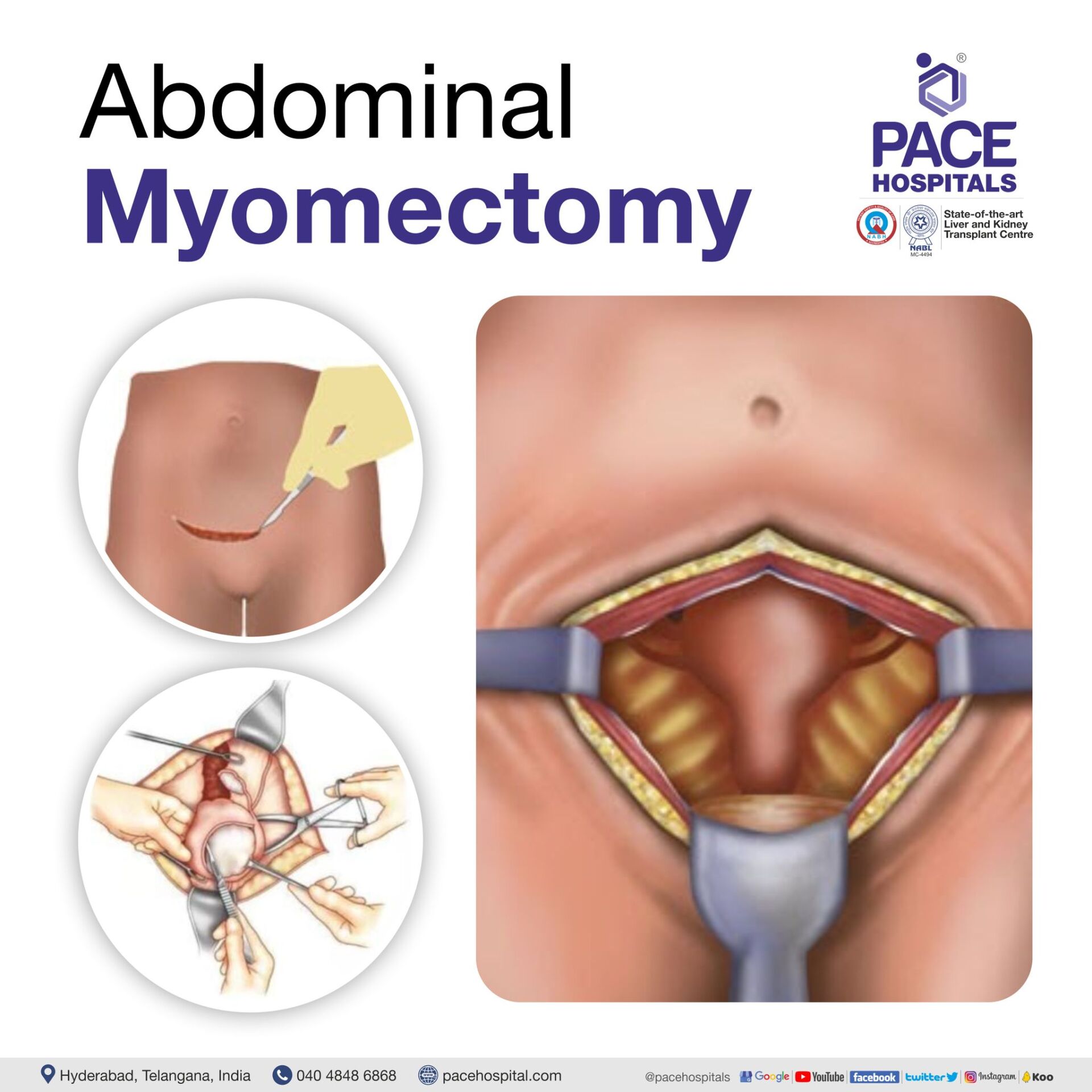 Abdominal Myomectomy in Hyderabad | Abdominal Myomectomy in India | Abdominal Myomectomy surgery | Abdominal Myomectomy Surgery Cost
