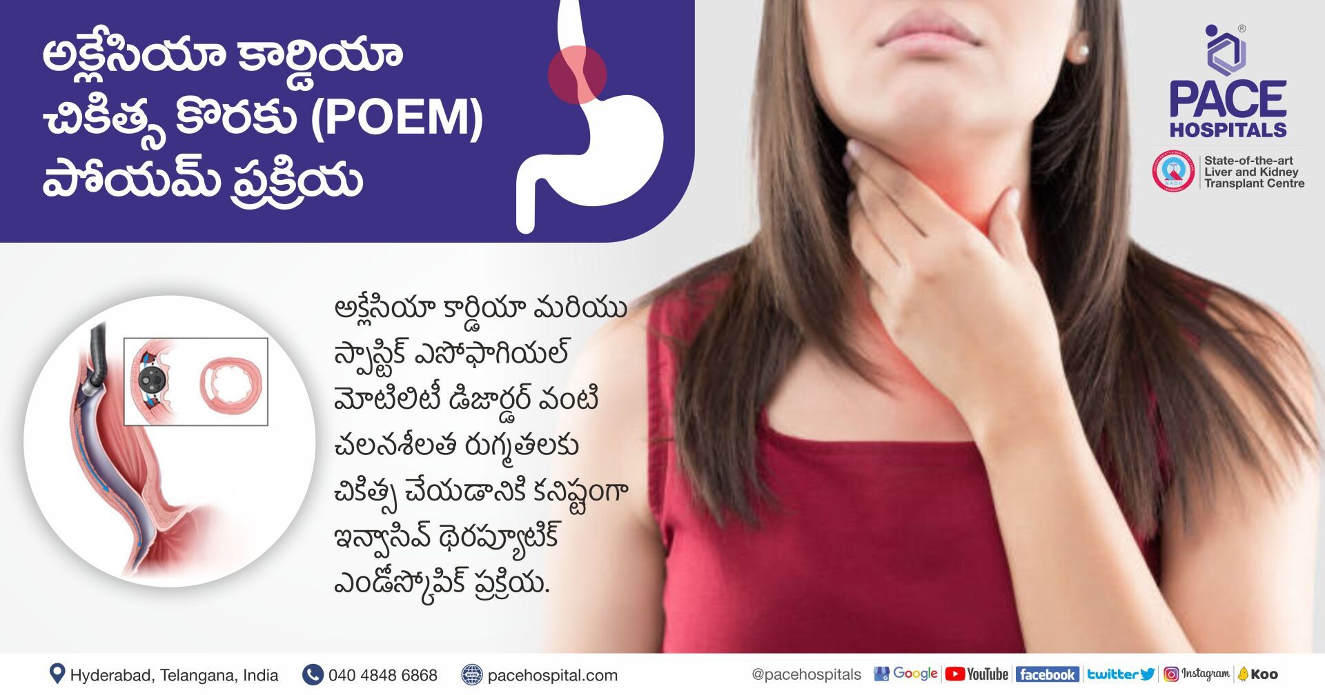 అకలేషియా కార్డియా చికిత్స కోసం POEM శస్త్రచికిత్స POEM Procedure