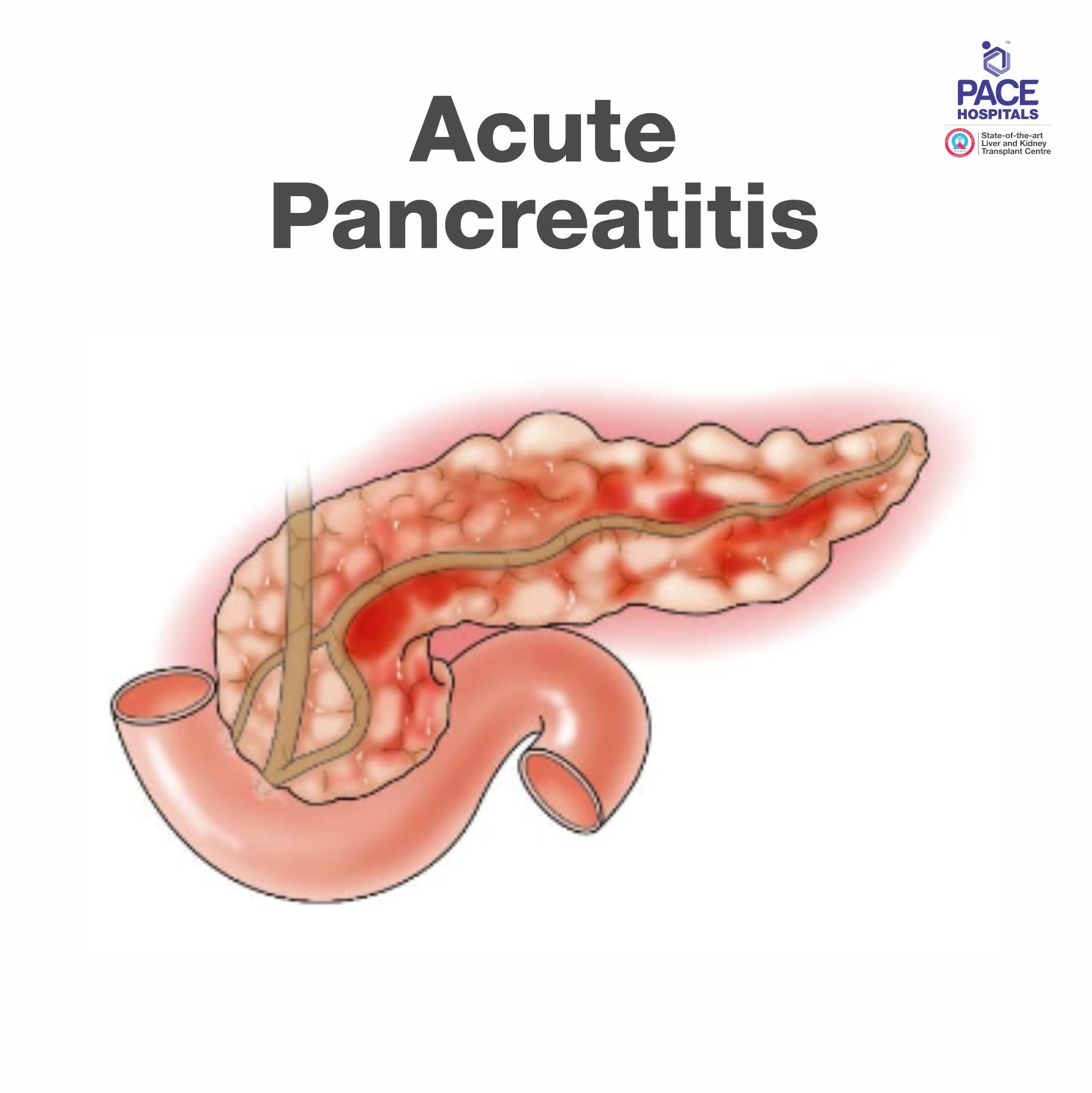 Best Hospital For Acute Pancreatitis Chronic Pancreatitis Treatment   Acute Pancreatitis Treatment In Hyderabad 1920w 