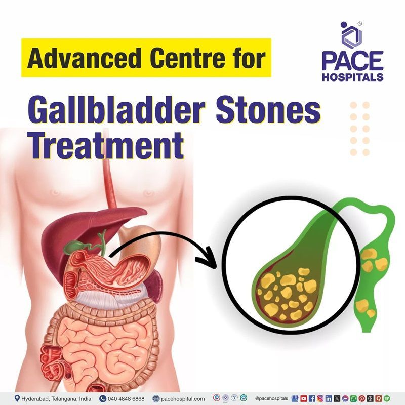 Best hospitals for Gallbladder stones Treatment in Hyderabad, India | Gallstones Treatment Hospital in Hyderabad, India | Centre for Gallstones Treatment in Hyderabad, India
