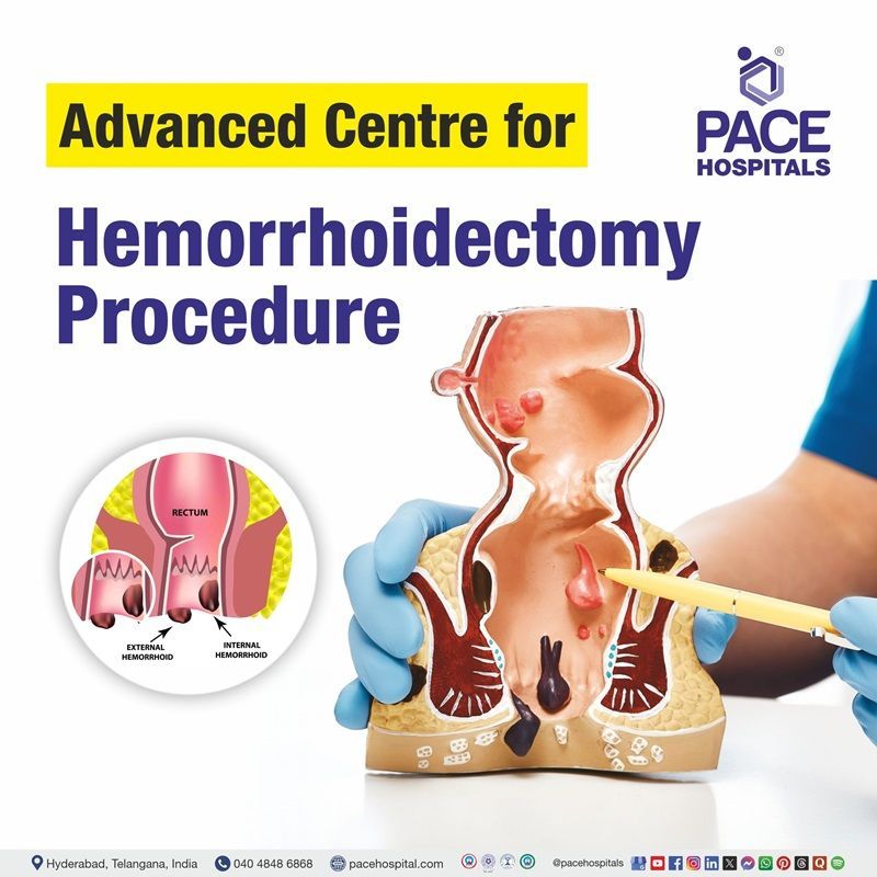 Best Hospital for Hemorrhoidectomy Surgery in Hyderabad, India | Hemorrhoidectomy Surgery hospital in Hyderabad, Telangana, India