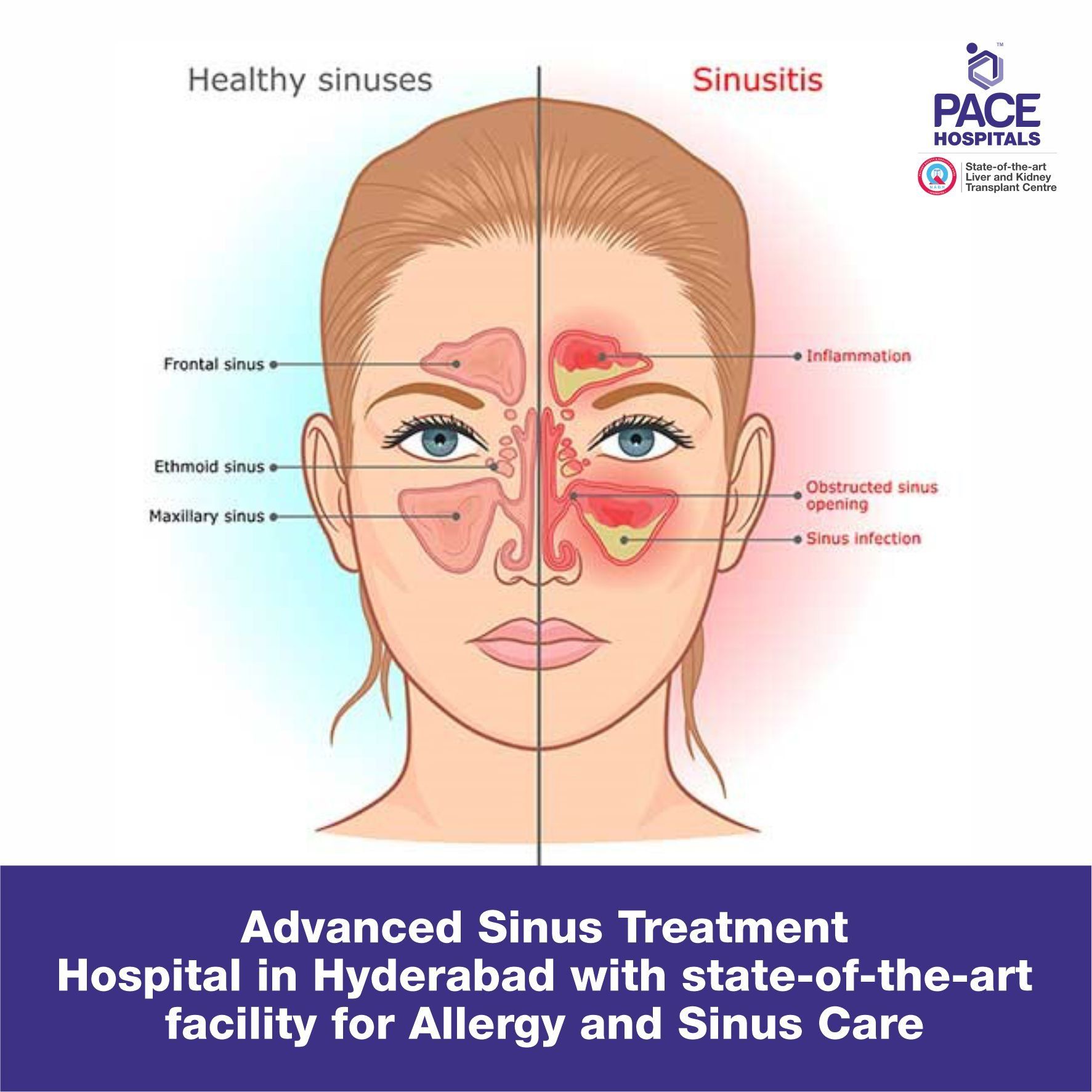 Advanced Sinus Treatment Hospital in Hyderabad with state-of-the-art-facility for Allergy and Sinus Care - Sinus Infections Treatment in Hyderabad
