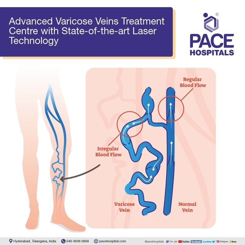 varicose veins treatment in hyderabad | varicose veins doctor | interventional radiology | interventional radiologists
