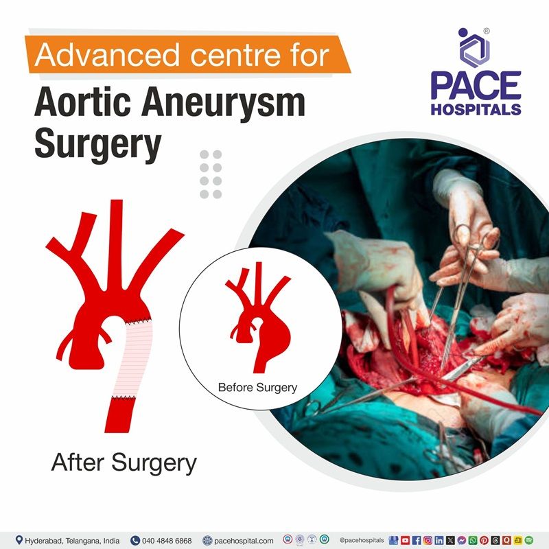 Best Hospital for Aortic Aneurysm Repair Surgery in Hyderabad, India | Advanced Center for Aortic Aneurysm Treatment in Hyderabad, India