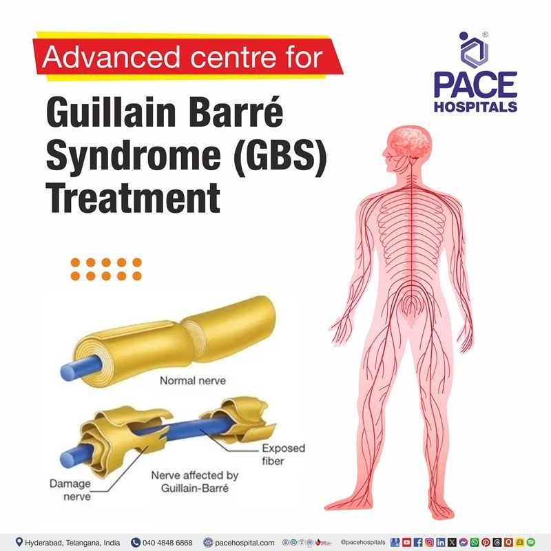 Daaweynta Guillain-Barré Syndrome (GBS) ee Hyderabad, Hindiya