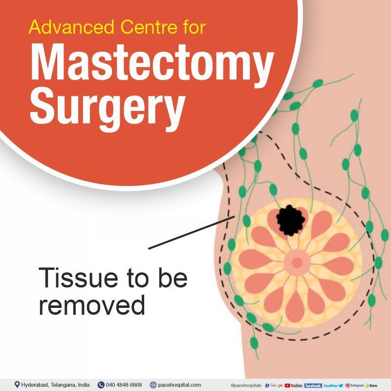 Best Hospital for Mastectomy surgery in Hyderabad, Telangana, India