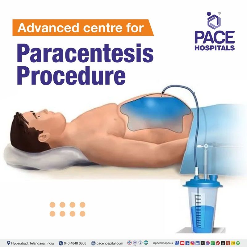 Best hospital for Paracentesis in Hyderabad, India | Abdominal fluid removal in Hyderabad 