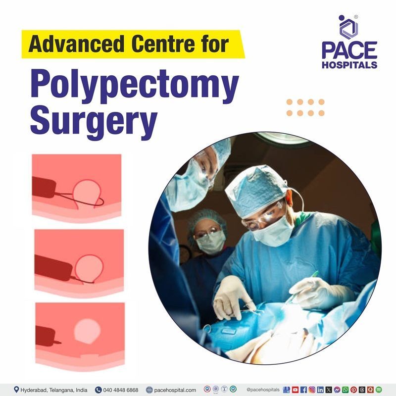 Best hospital for Polypectomy surgery in Hyderabad | Polypectomy surgery cost in Hyderabad | Polyps Removal Surgery hospital in Hyderabad, India