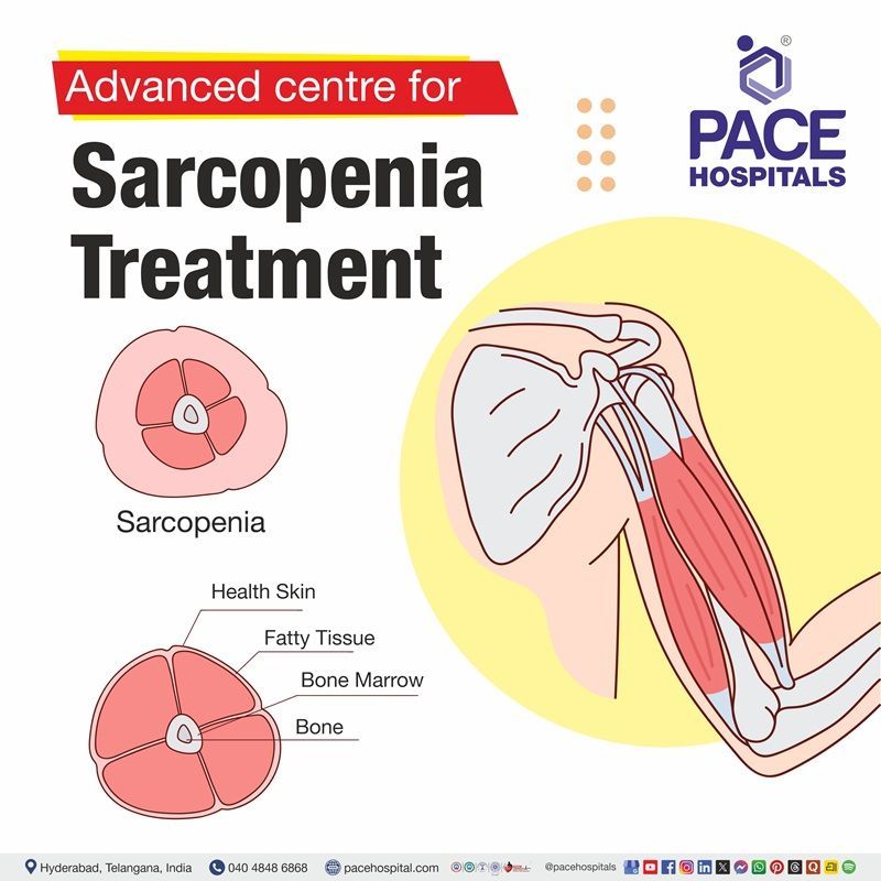 Top hospital for Sarcopenia treatment in Hyderabad, India | Sarcopenia Treatment near me