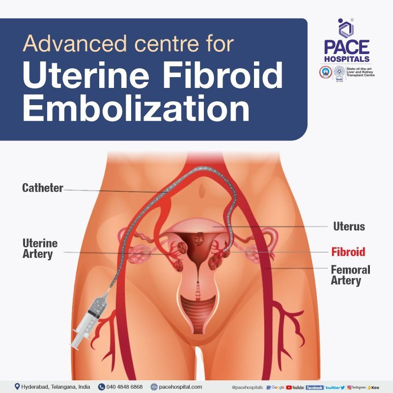 uterine fibroid embolization cost in Hyderabad | uterine artery embolization cost in India | uterine fibroid embolization cost in India | UFE procedure