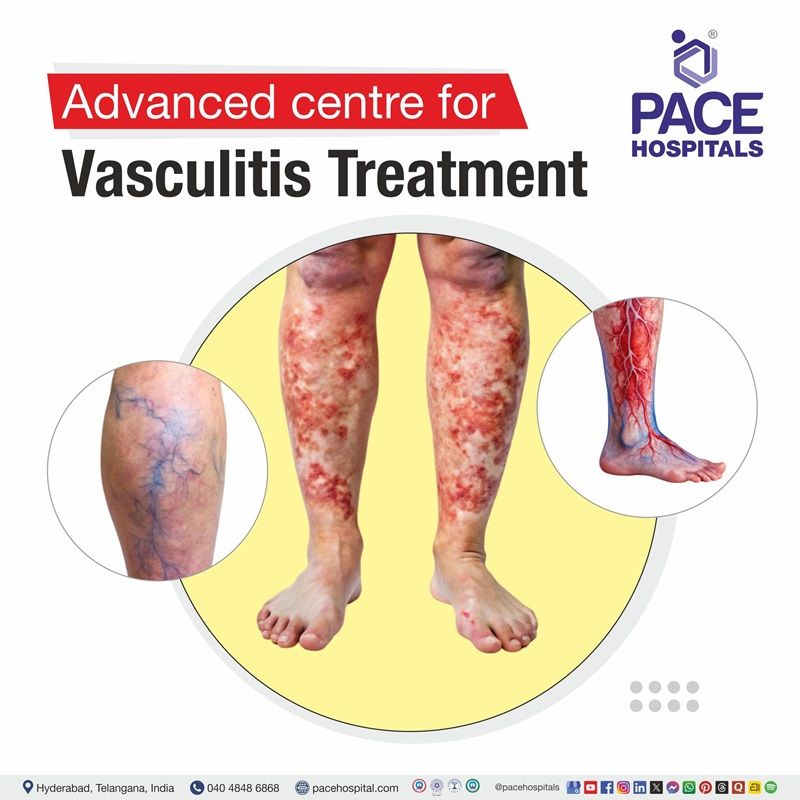 Best Hospital for Vasculitis diagnosis and  Treatment in Hyderabad | Vasculitis treatment hospital in Hyderabad, India
