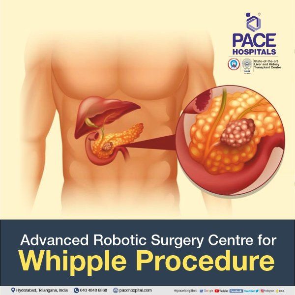 Whipple Procedure for Pancreatic Cancer | whipple procedure cost in india | whipple operation | Whipple surgery cost in Hyderabad