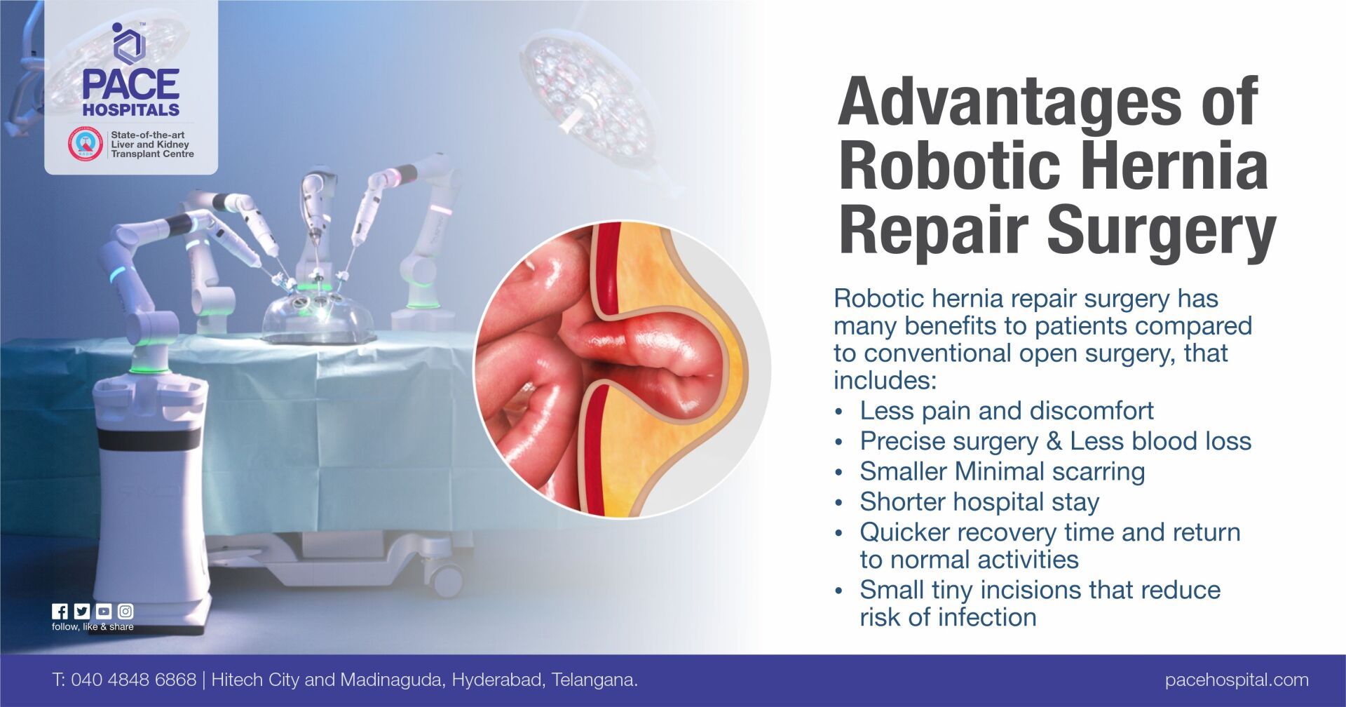 Advantages and Benefits of Robotic Hernia Repair Surgery in Hyderabad