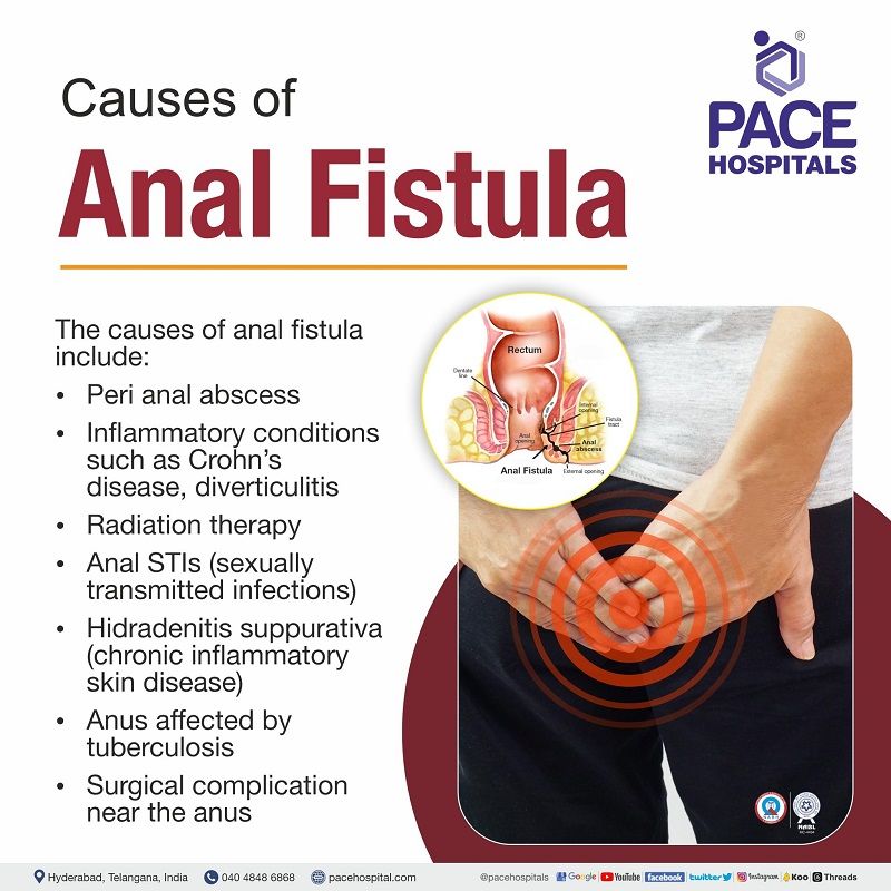 anal fistula causes | what causes anal fistula | fistula ano causes | causes for fistula in ano | about anal fistula causes and types