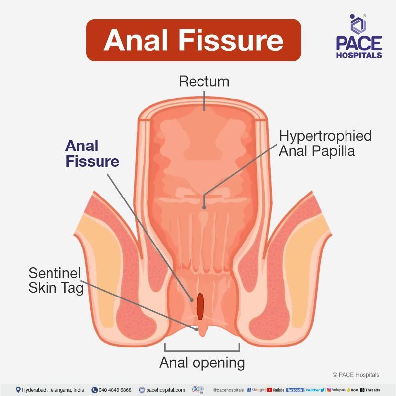 anal fissure picture | fissure in ano images | chronic anal fissure skin tag | anorectal fissure | anal fissure real images