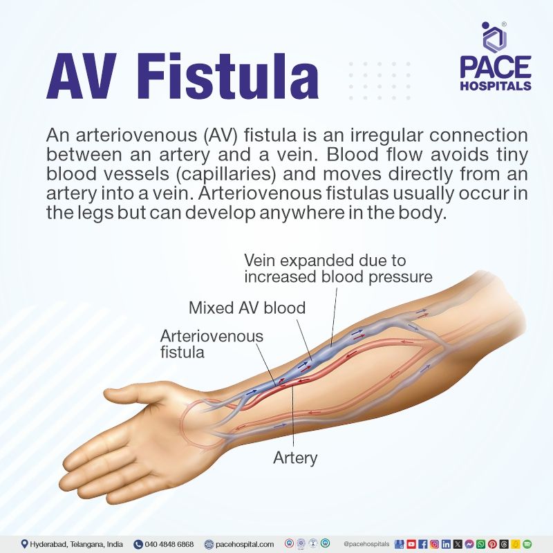 AV fistula | What is an AV fistula | AV fistula meaning | AV fistula definition | AV fistula procedure | Visual explaining the meaning of AV Fistula