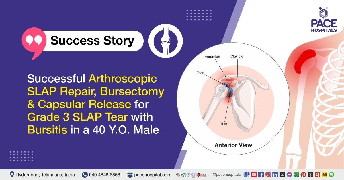 Successful Arthroscopic SLAP Repair & Bursectomy done for SLAP Tear Treatment at PACE Hospitals