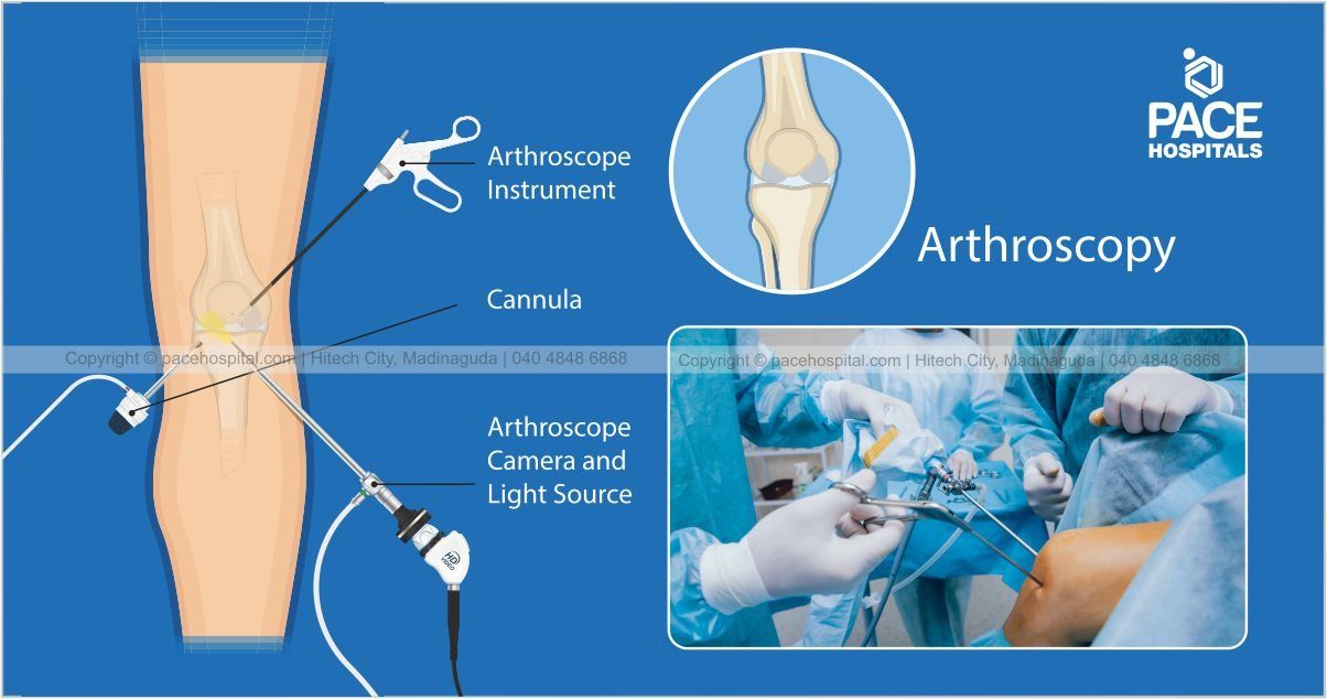Arthroscopy assisted fixations for bone fractures and fractures around joints
