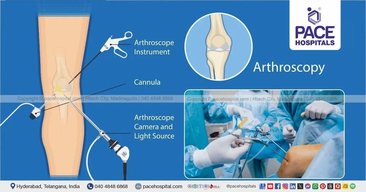 Arthroscopy assisted fixations for bone fractures and fractures around joints
