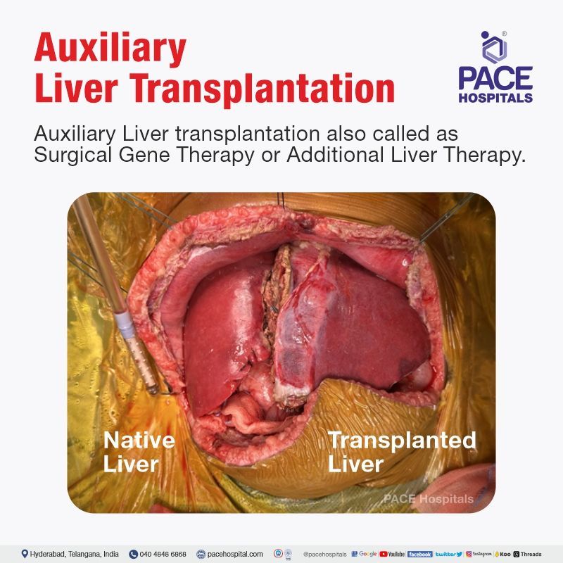 Auxiliary liver transplantation for Propionic Acidemia | the best hospital for liver transplant in India | Top Liver transplant surgeons | Surgical Gene Therapy | Additional Liver Therapy
