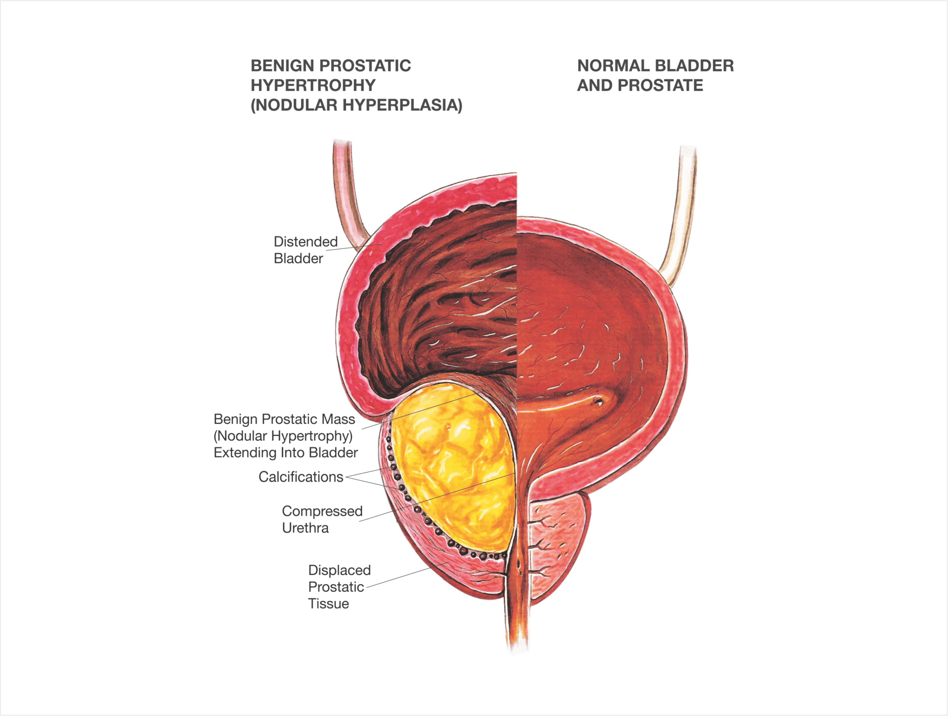 Laser removal of prostate - HoLEP (Holmium Laser Enucleation of the Prostate)