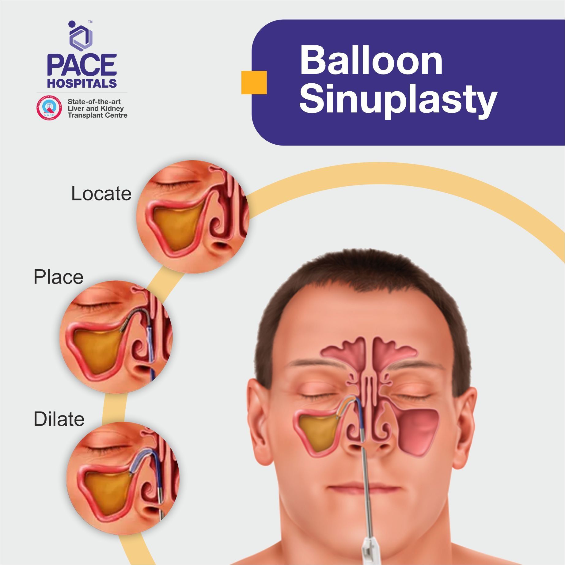 Balloon Sinuplasty Sinus Surgery in Hyderabad, Telangana, India