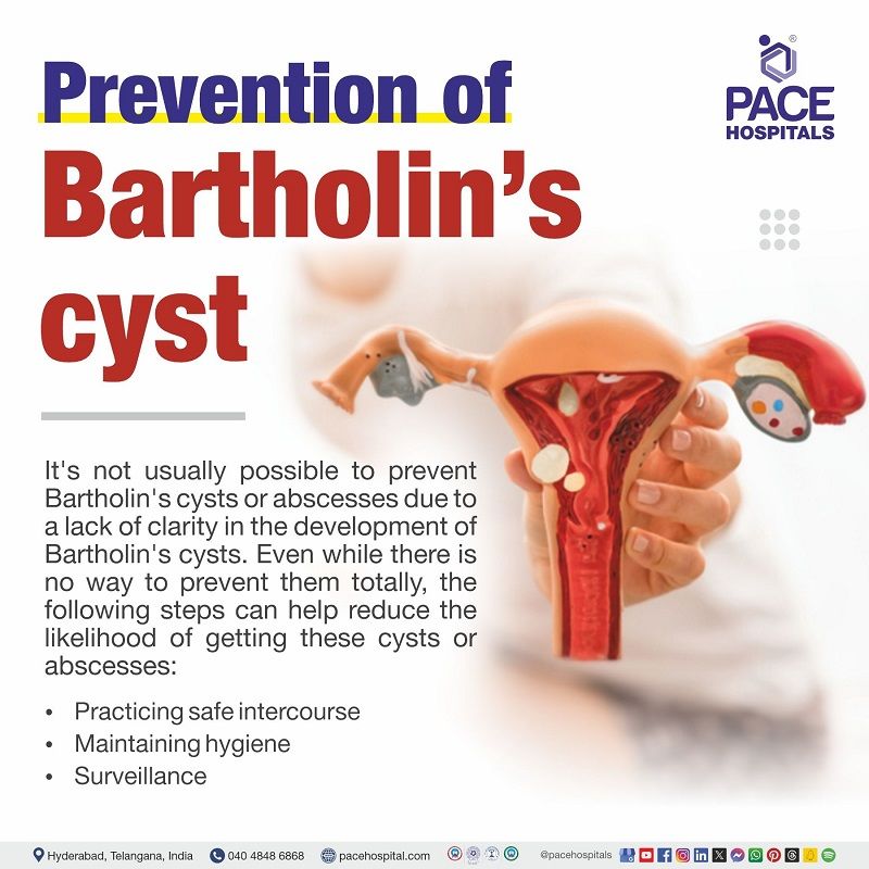 Bartholin cyst prevention | Bartholin gland cyst prevention | preventive tips for Bartholin cyst | Visual depicting the | preventive measure for Bartholin cyst 
