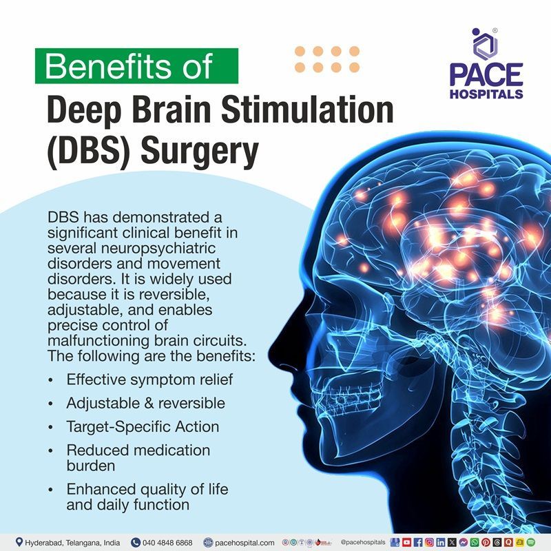 Deep Brain Stimulation Surgery (DBS) Benefits visual depicting the advantages of DBS surgery | Benefits of Deep brain stimulation surgery
